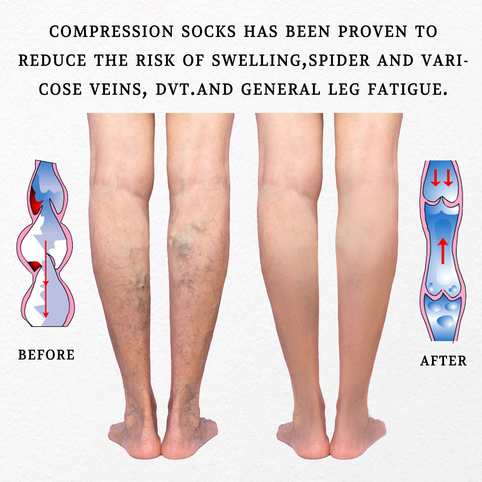 15-20 mmHg Compression Socks for Women and Men Knee High Open Toe