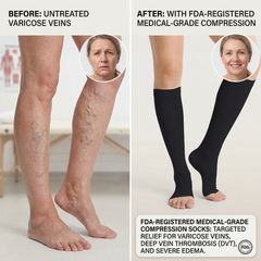 Open-Toe Compression Socks (FDA-listed)